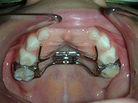 Le port d'un disjoncteur en orthodontie pour enfants