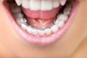 Traitement orthodontique pour adulte avec bagues